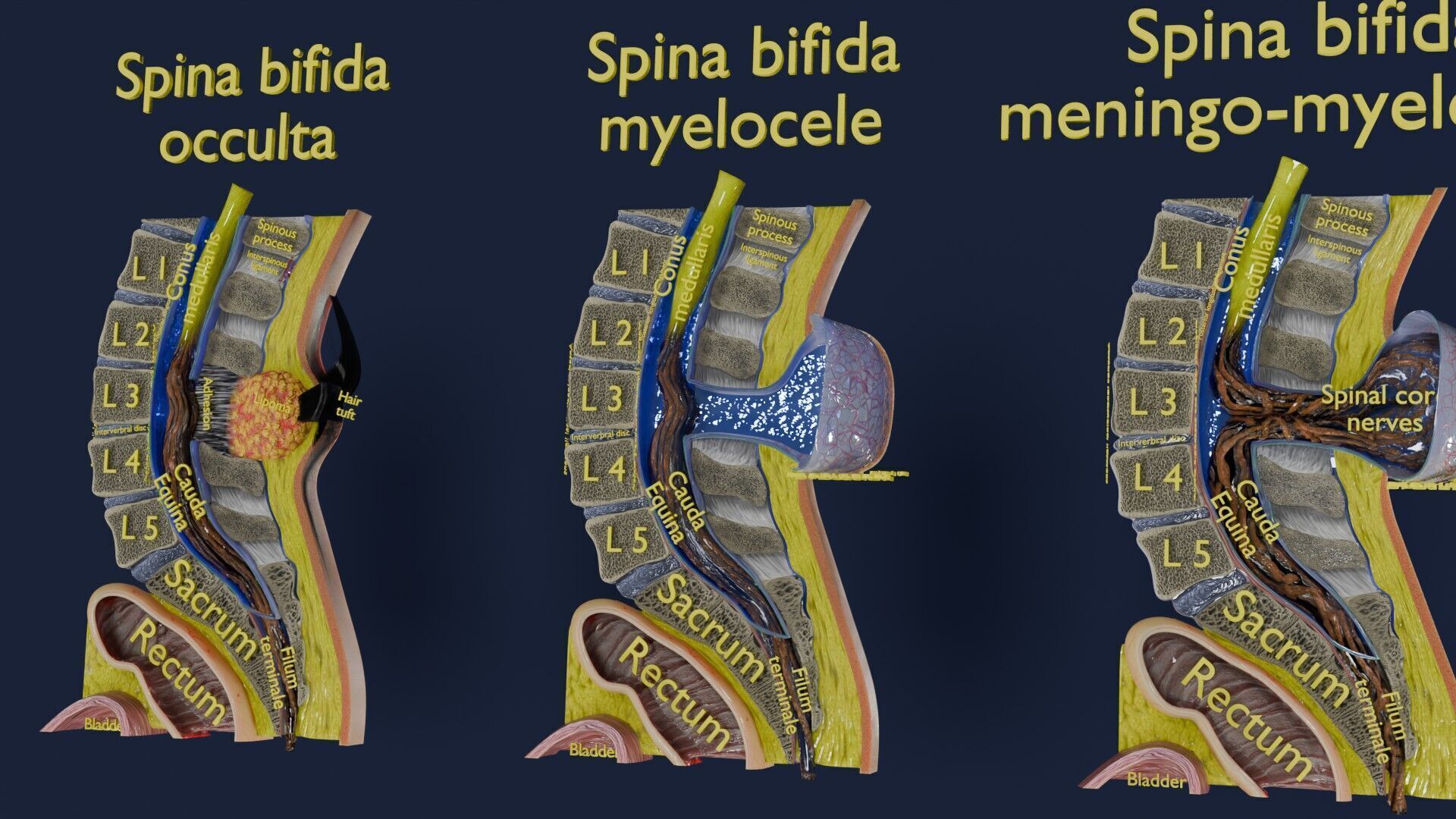 Spina bifida Neural Tube Defect Low-poly 3D model_33