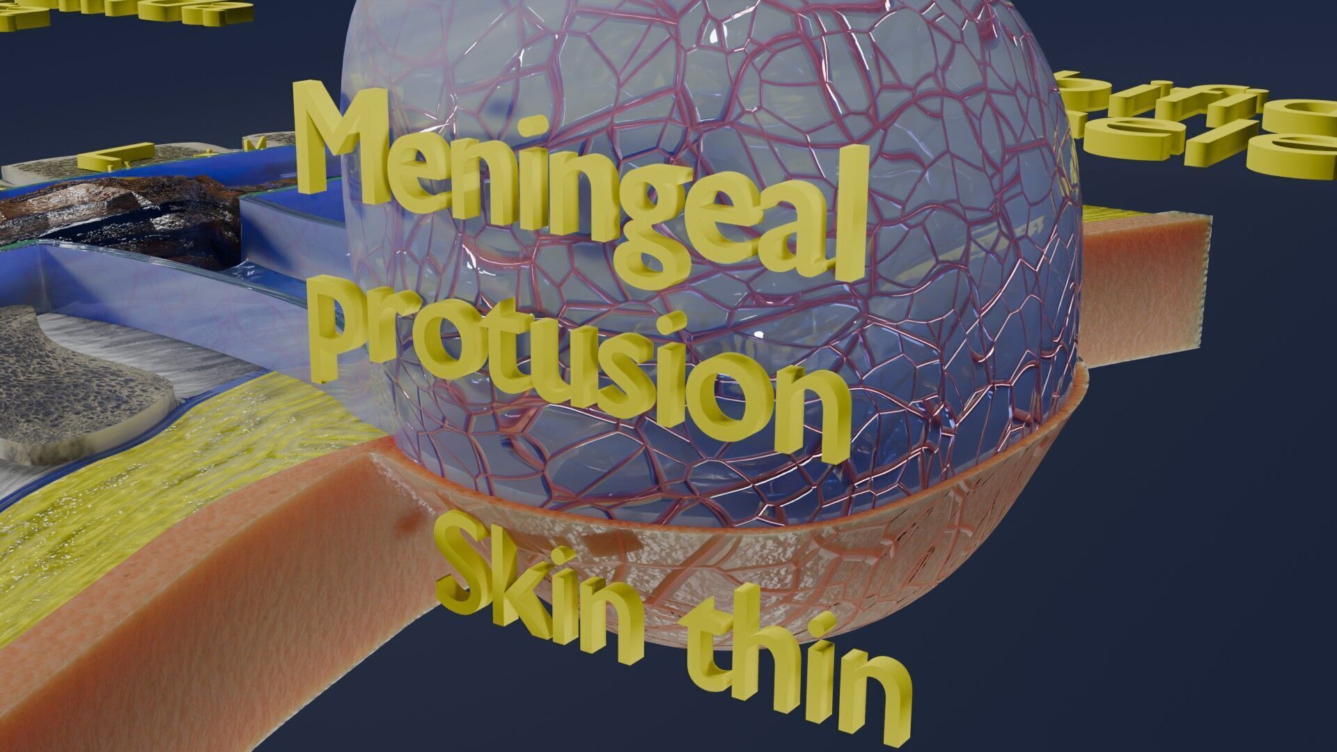 Spina bifida Neural Tube Defect Low-poly 3D model_40