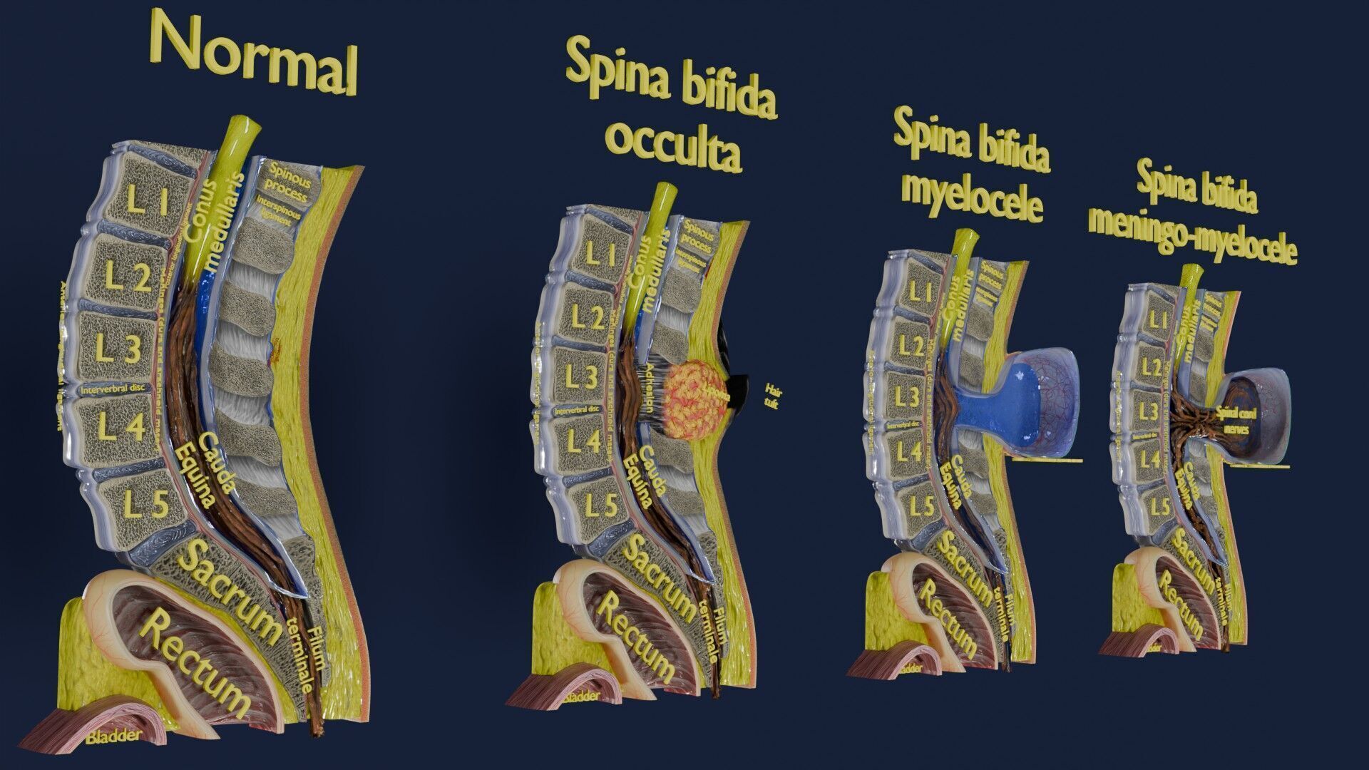 Spina bifida Neural Tube Defect Low-poly 3D model_6