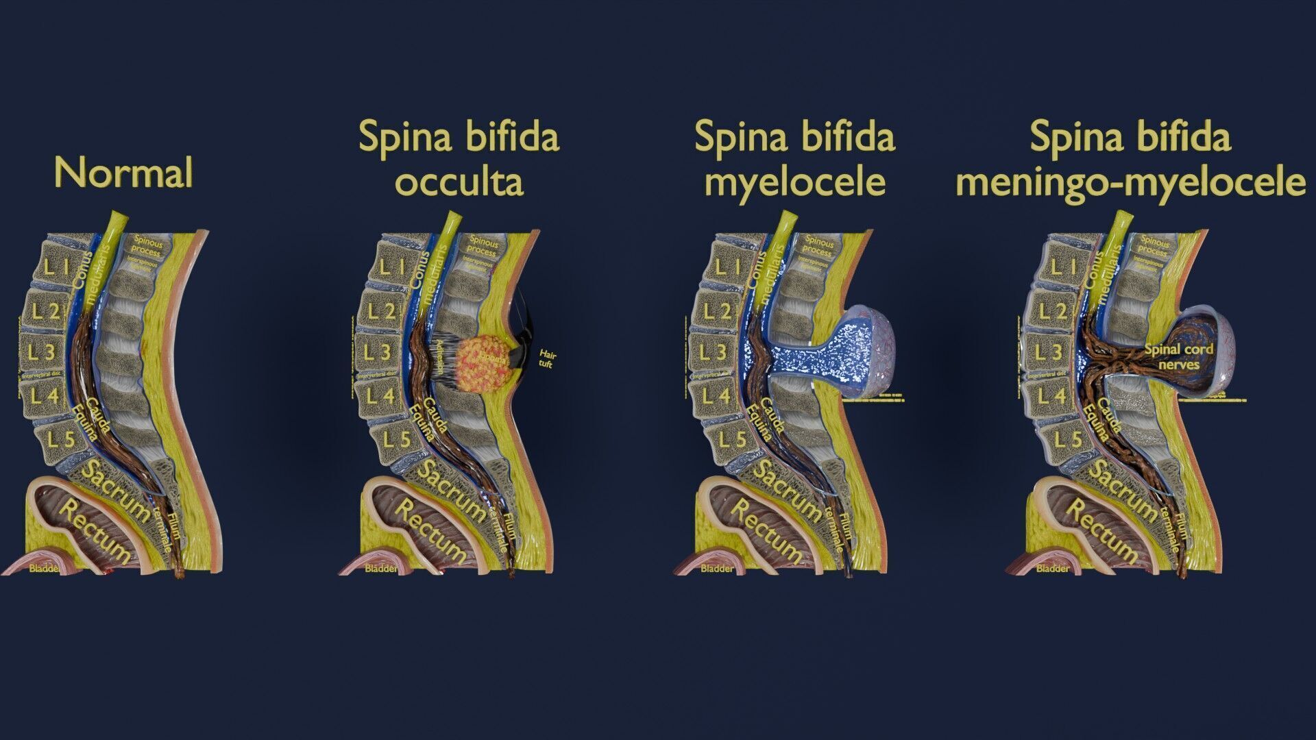 Spina bifida Neural Tube Defect Low-poly 3D model_9