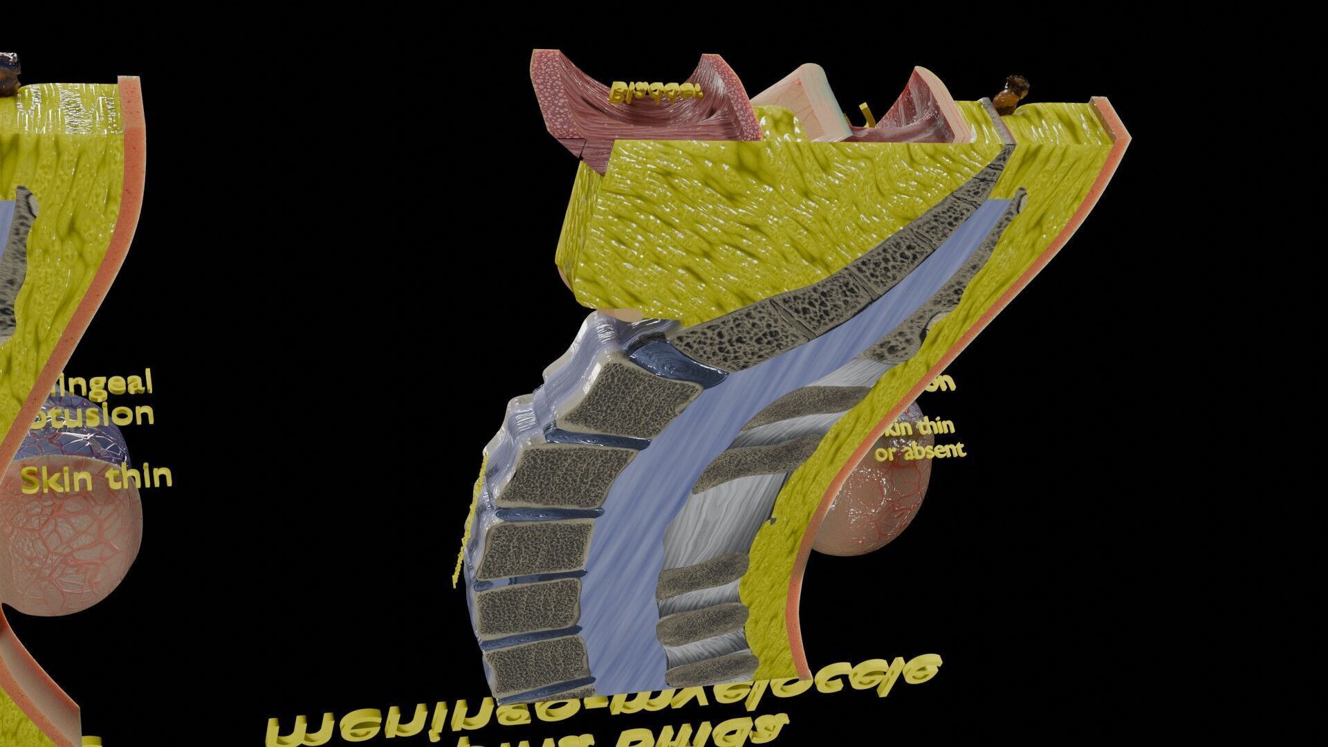 Spina bifida Neural Tube Defect Low-poly 3D model_55