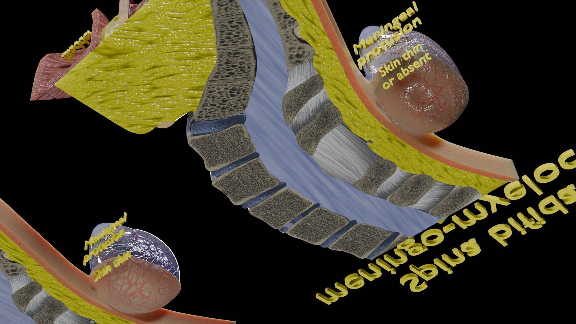 Spina bifida Neural Tube Defect Low-poly 3D model_49