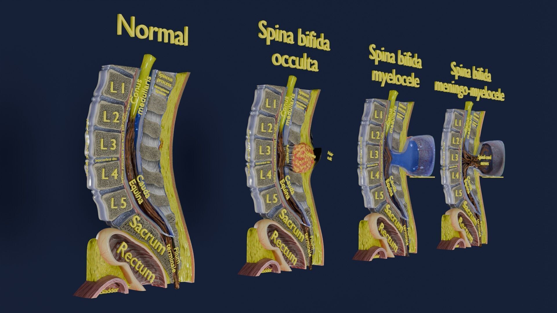 Spina bifida Neural Tube Defect Low-poly 3D model_4