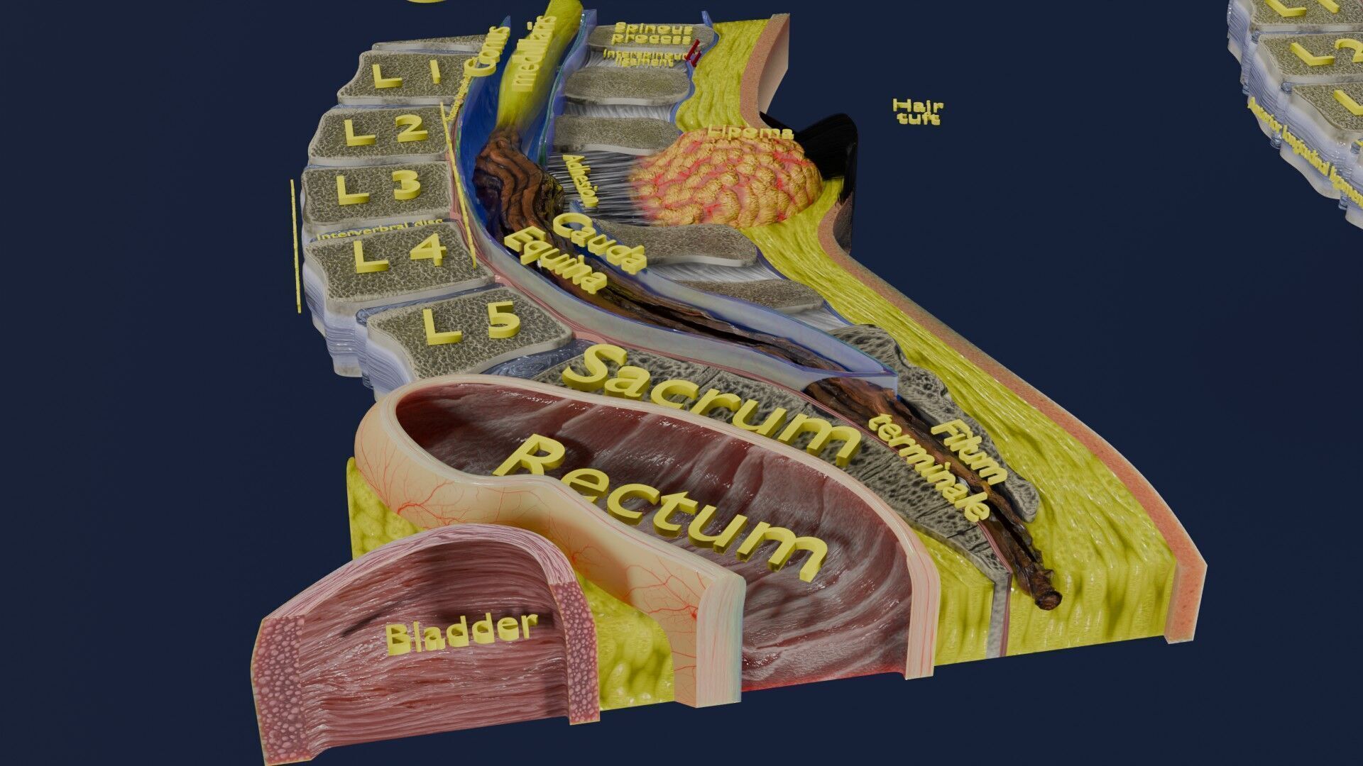 Spina bifida Neural Tube Defect Low-poly 3D model_21