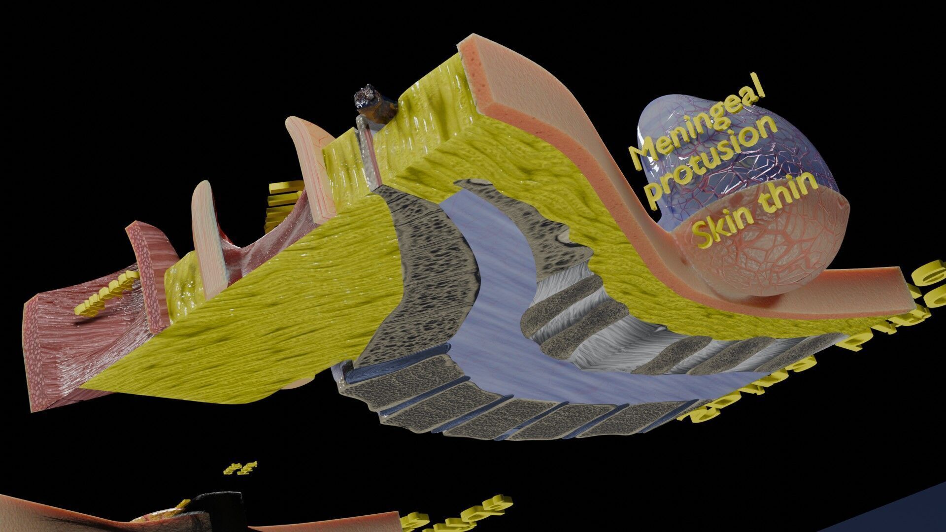 Spina bifida Neural Tube Defect Low-poly 3D model_43