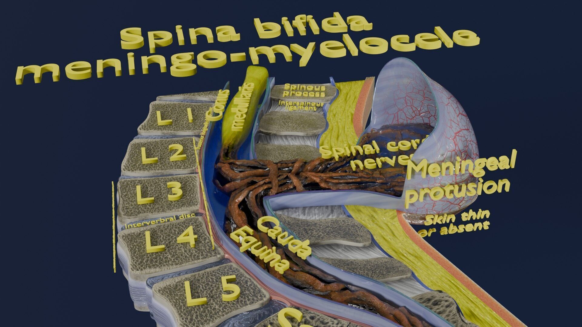 Spina bifida Neural Tube Defect Low-poly 3D model_46