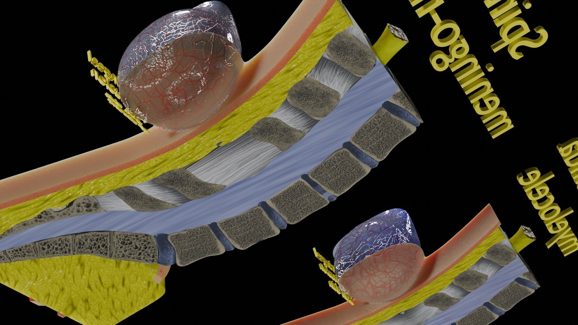 Spina bifida Neural Tube Defect Low-poly 3D model_69