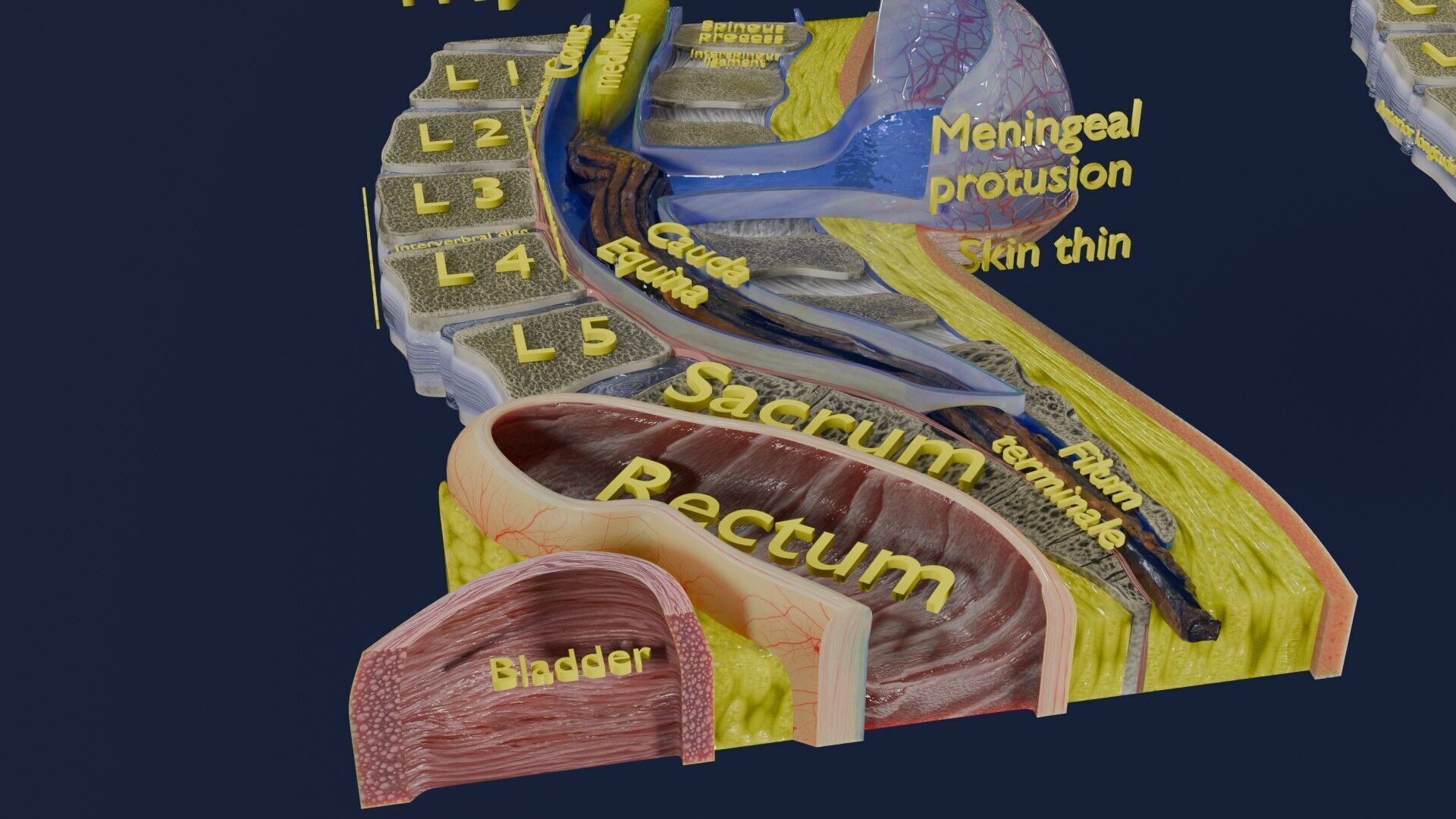 Spina bifida Neural Tube Defect Low-poly 3D model_61