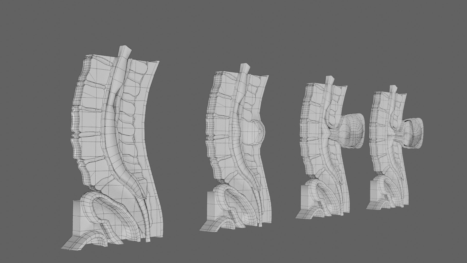 Spina bifida Neural Tube Defect Low-poly 3D model_75