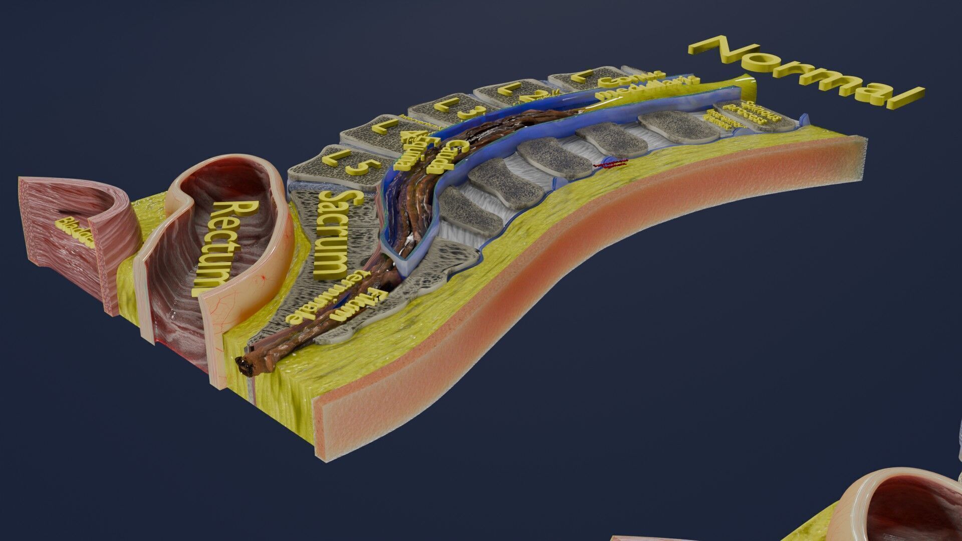 Spina bifida Neural Tube Defect Low-poly 3D model_8