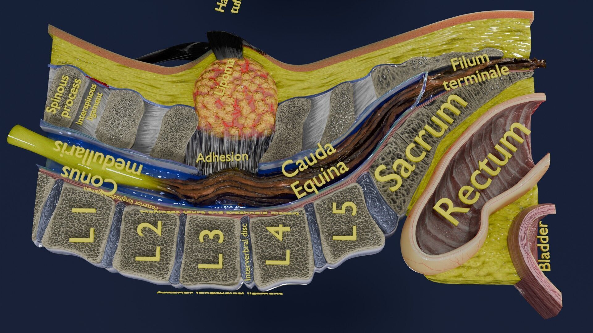 Spina bifida Neural Tube Defect Low-poly 3D model_28