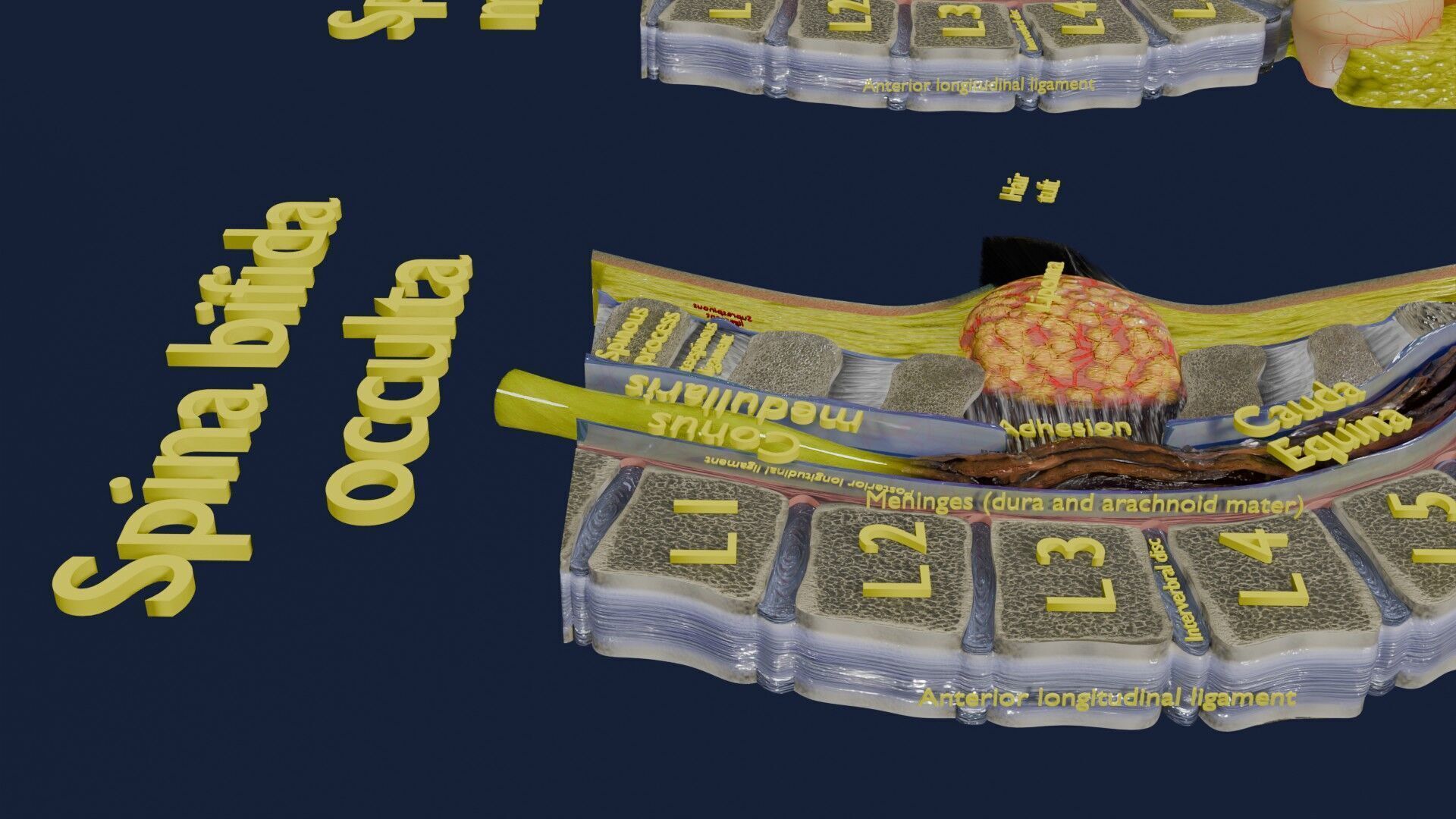 Spina bifida Neural Tube Defect Low-poly 3D model_22