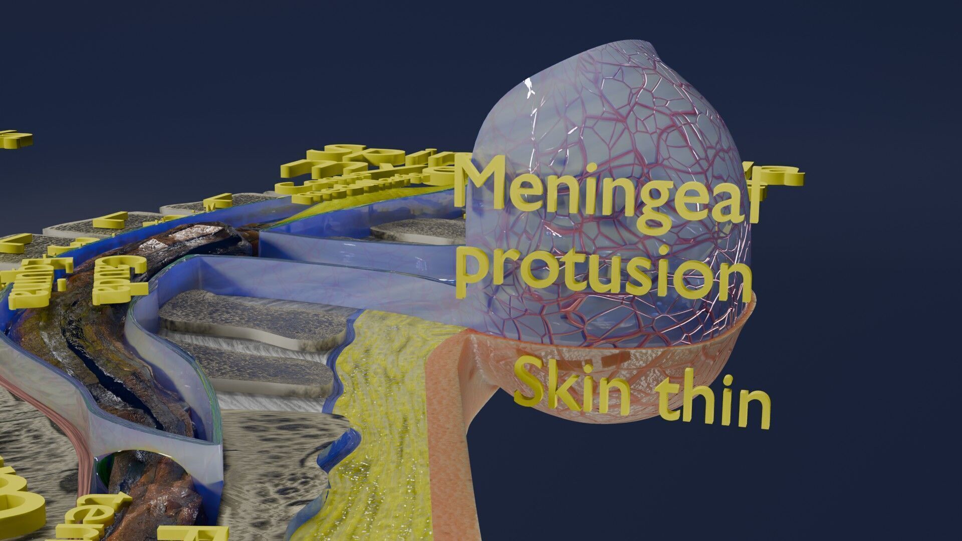 Spina bifida Neural Tube Defect Low-poly 3D model_39