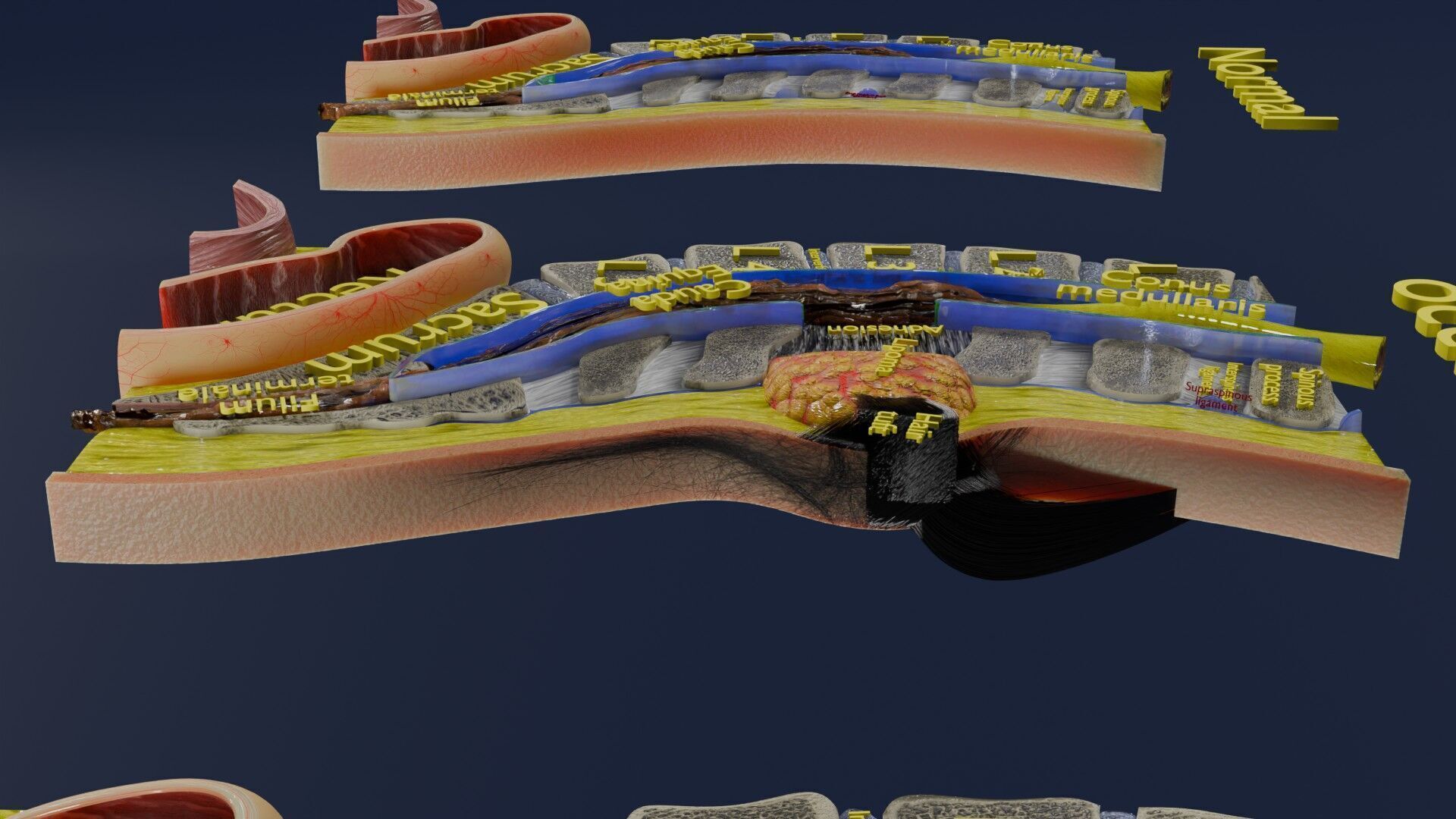 Spina bifida Neural Tube Defect Low-poly 3D model_37