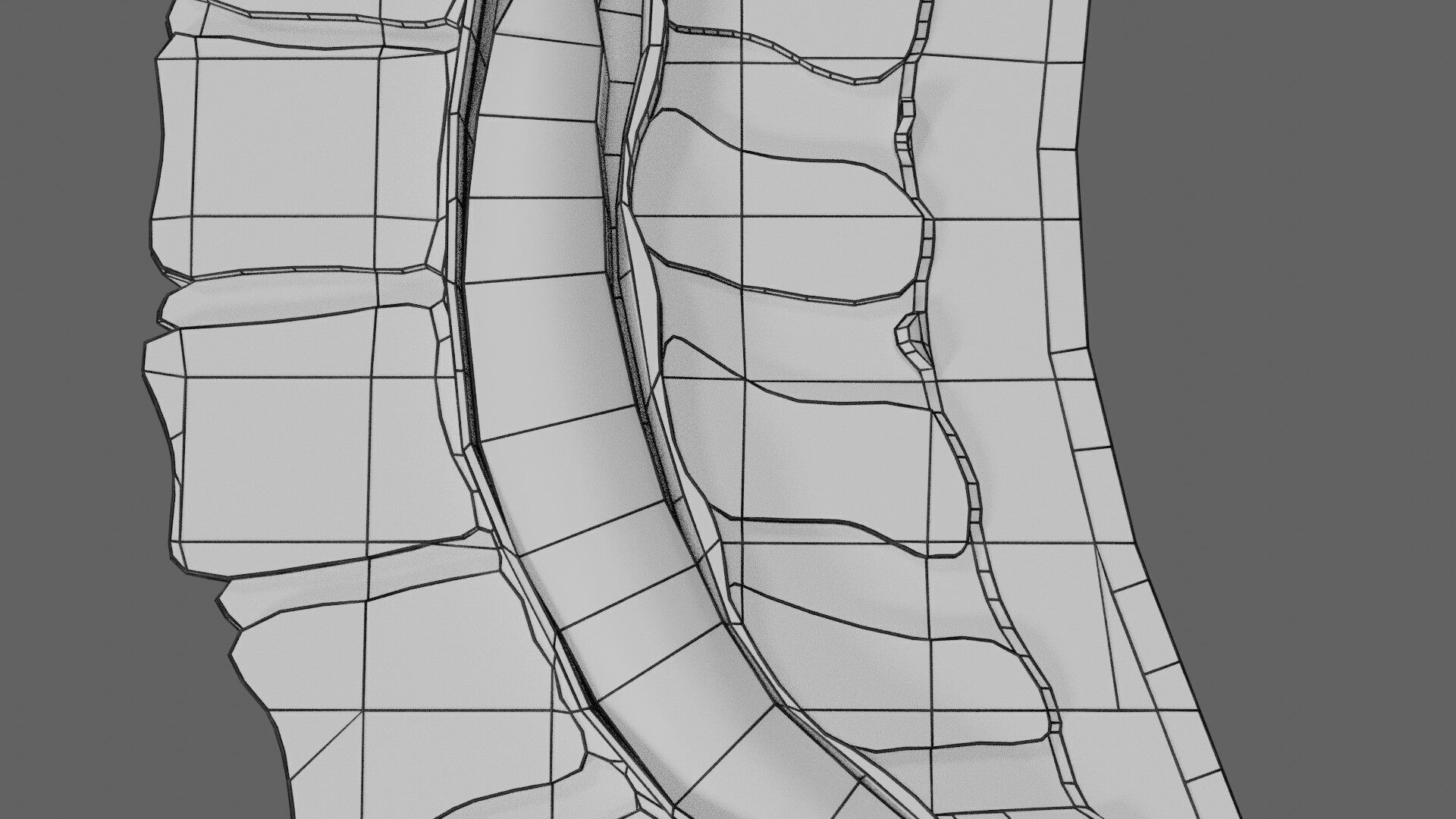 Spina bifida Neural Tube Defect Low-poly 3D model_98