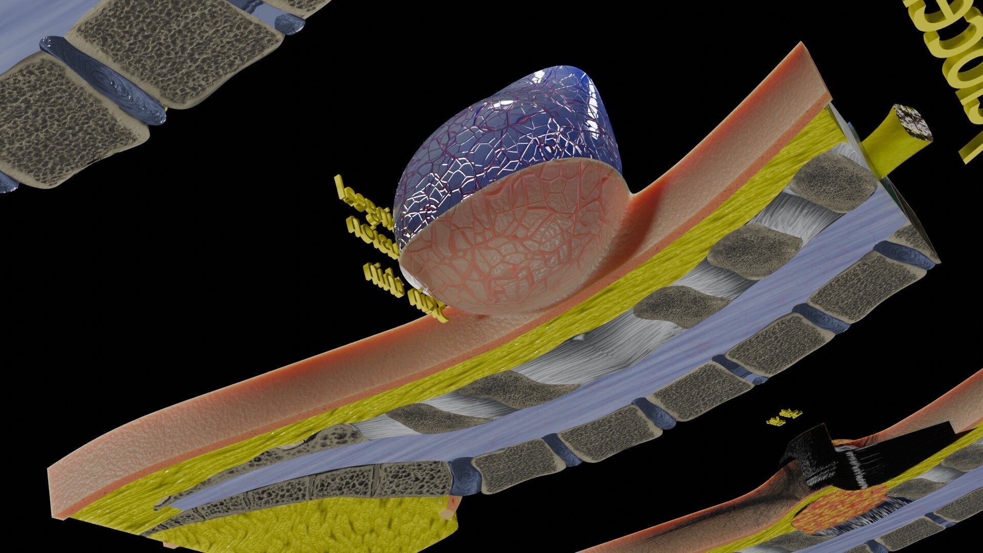 Spina bifida Neural Tube Defect Low-poly 3D model_60