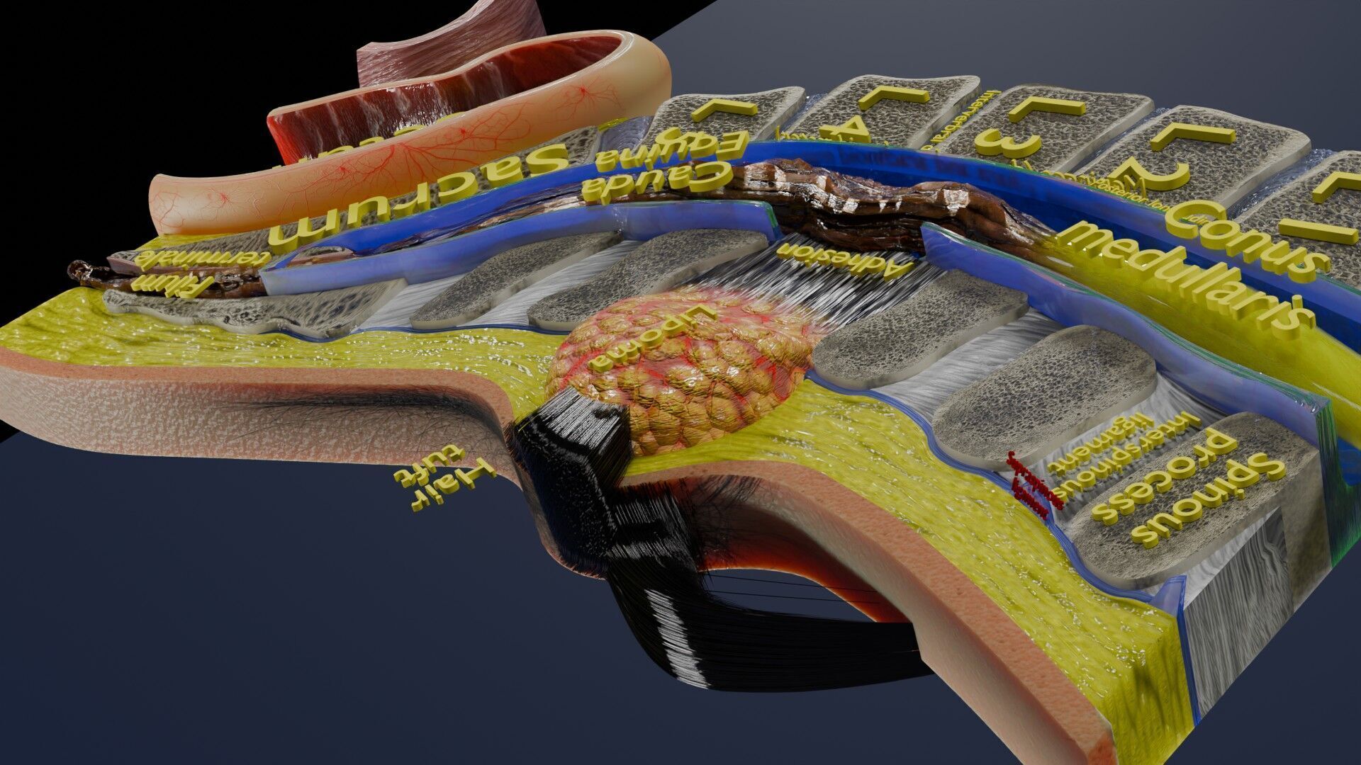 Spina bifida Neural Tube Defect Low-poly 3D model_34