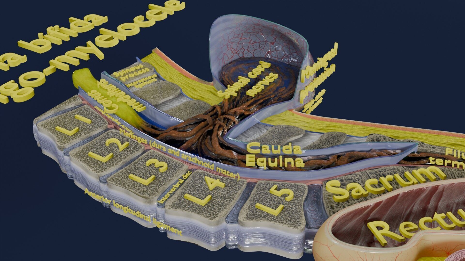 Spina bifida Neural Tube Defect Low-poly 3D model_45