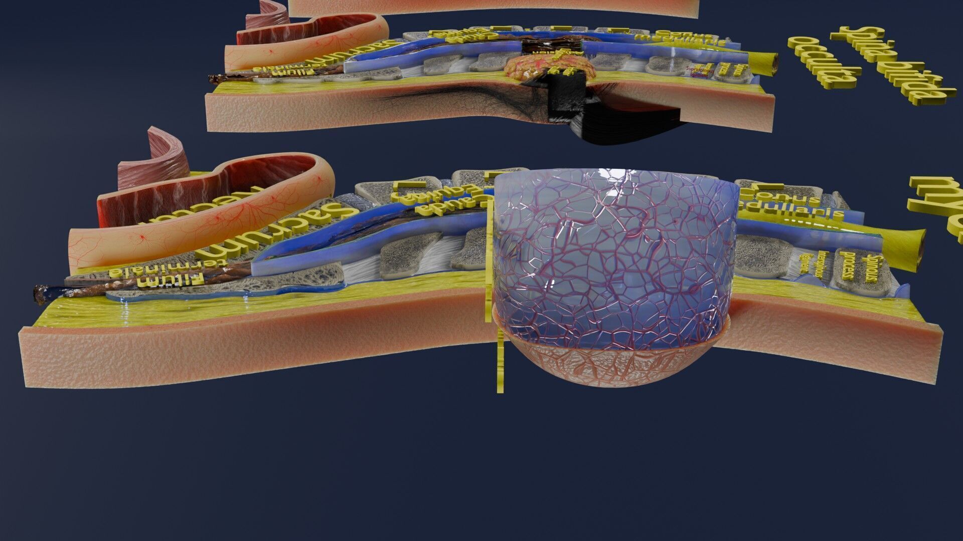 Spina bifida Neural Tube Defect Low-poly 3D model_44