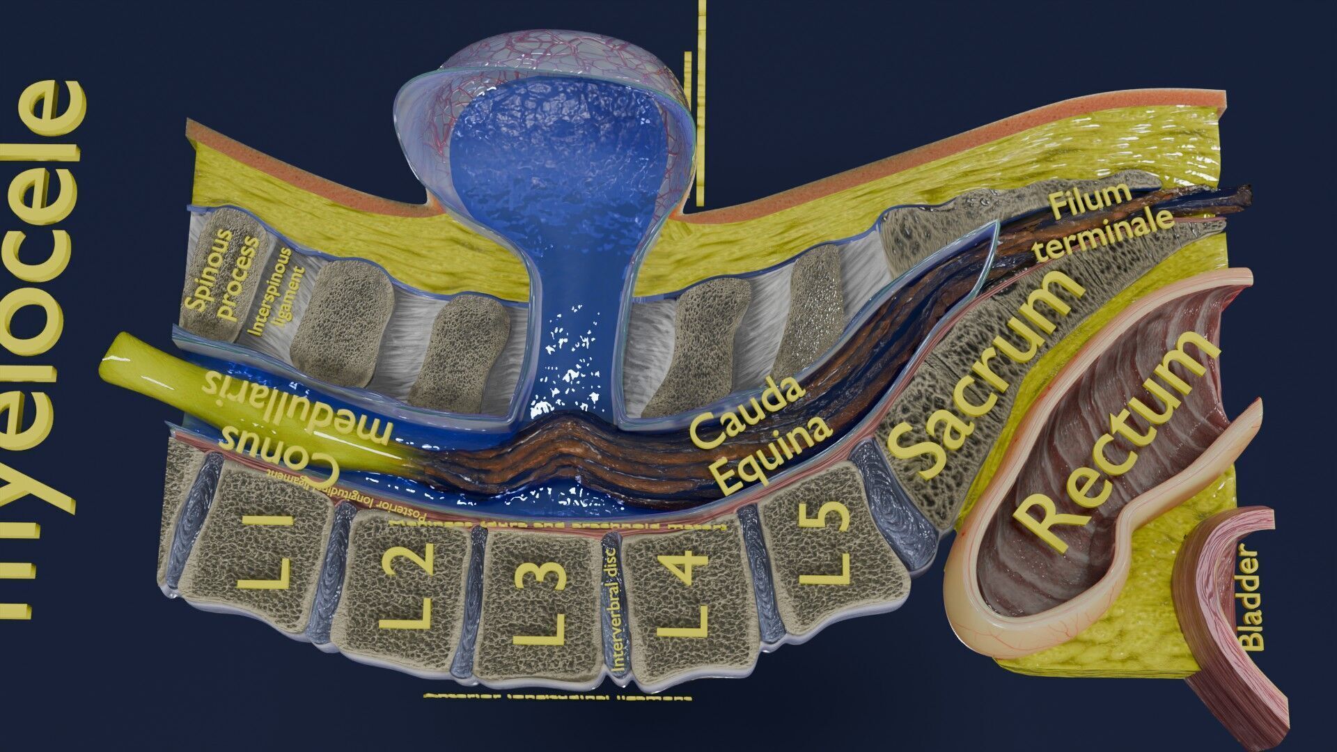 Spina bifida Neural Tube Defect Low-poly 3D model_35