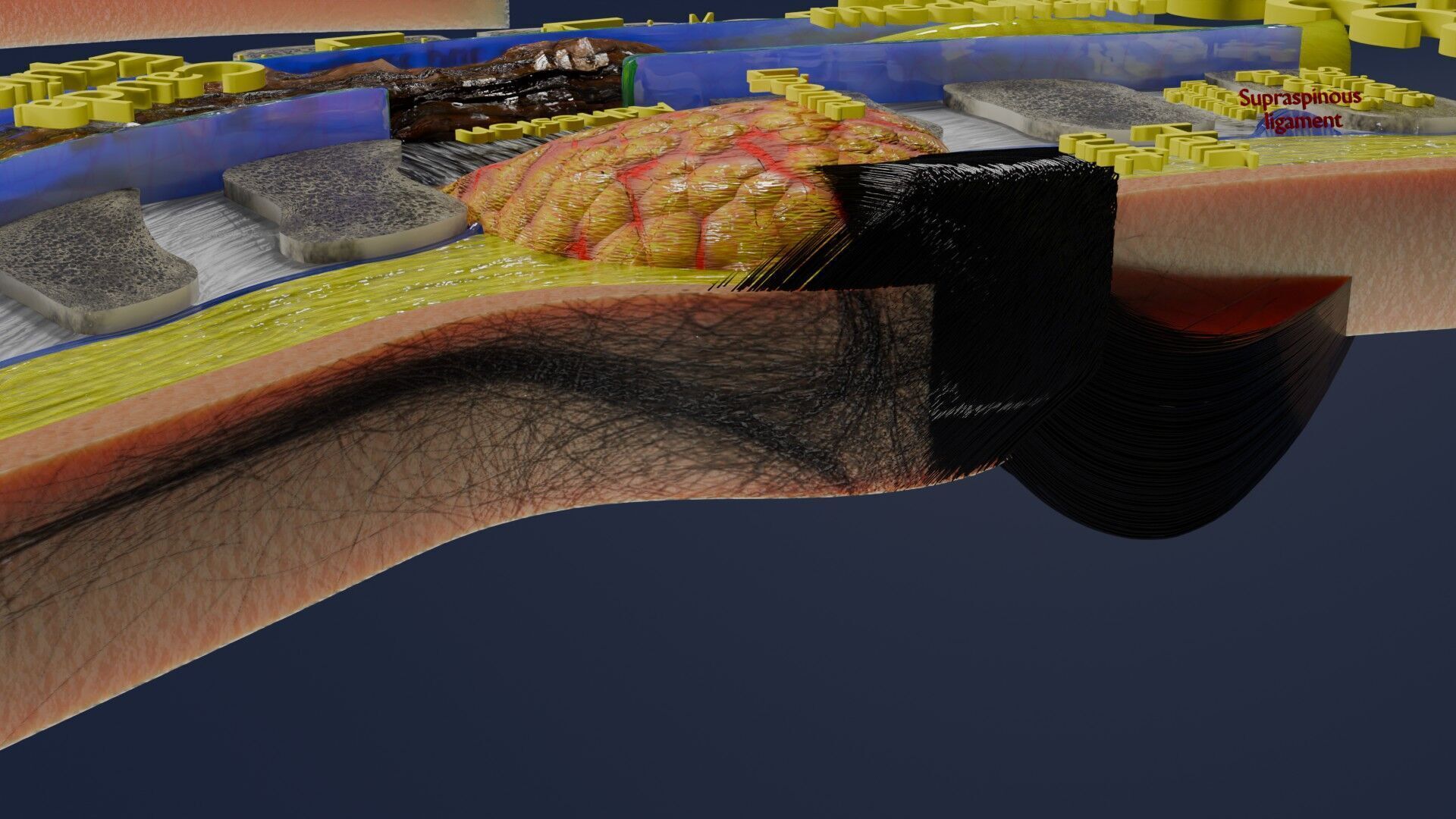 Spina bifida Neural Tube Defect Low-poly 3D model_57