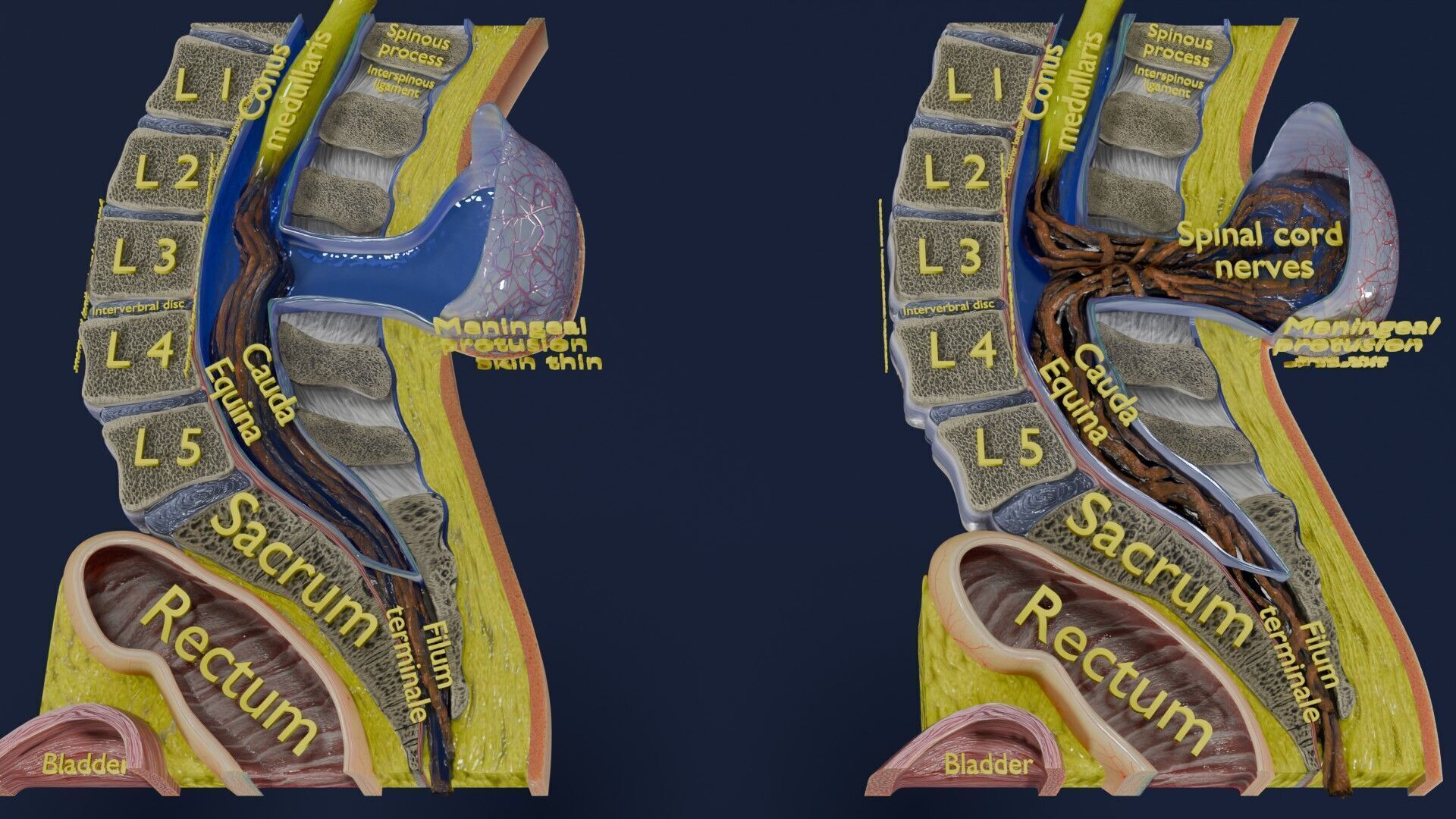 Spina bifida Neural Tube Defect Low-poly 3D model_53