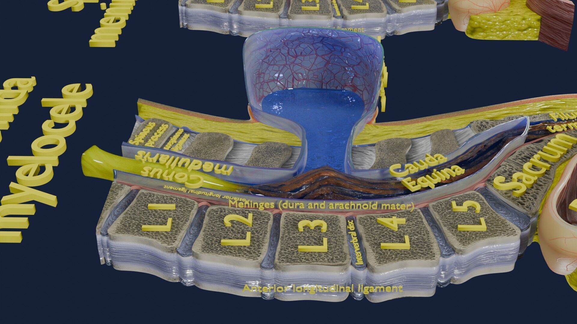 Spina bifida Neural Tube Defect Low-poly 3D model_63