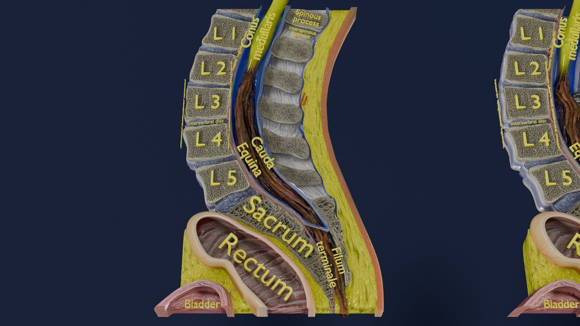 Spina bifida Neural Tube Defect Low-poly 3D model_16