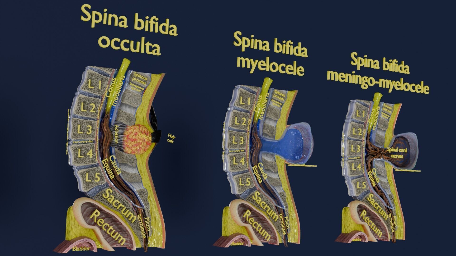Spina bifida Neural Tube Defect Low-poly 3D model_3