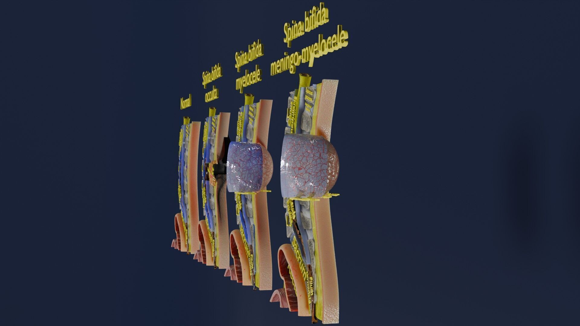 Spina bifida Neural Tube Defect Low-poly 3D model_13