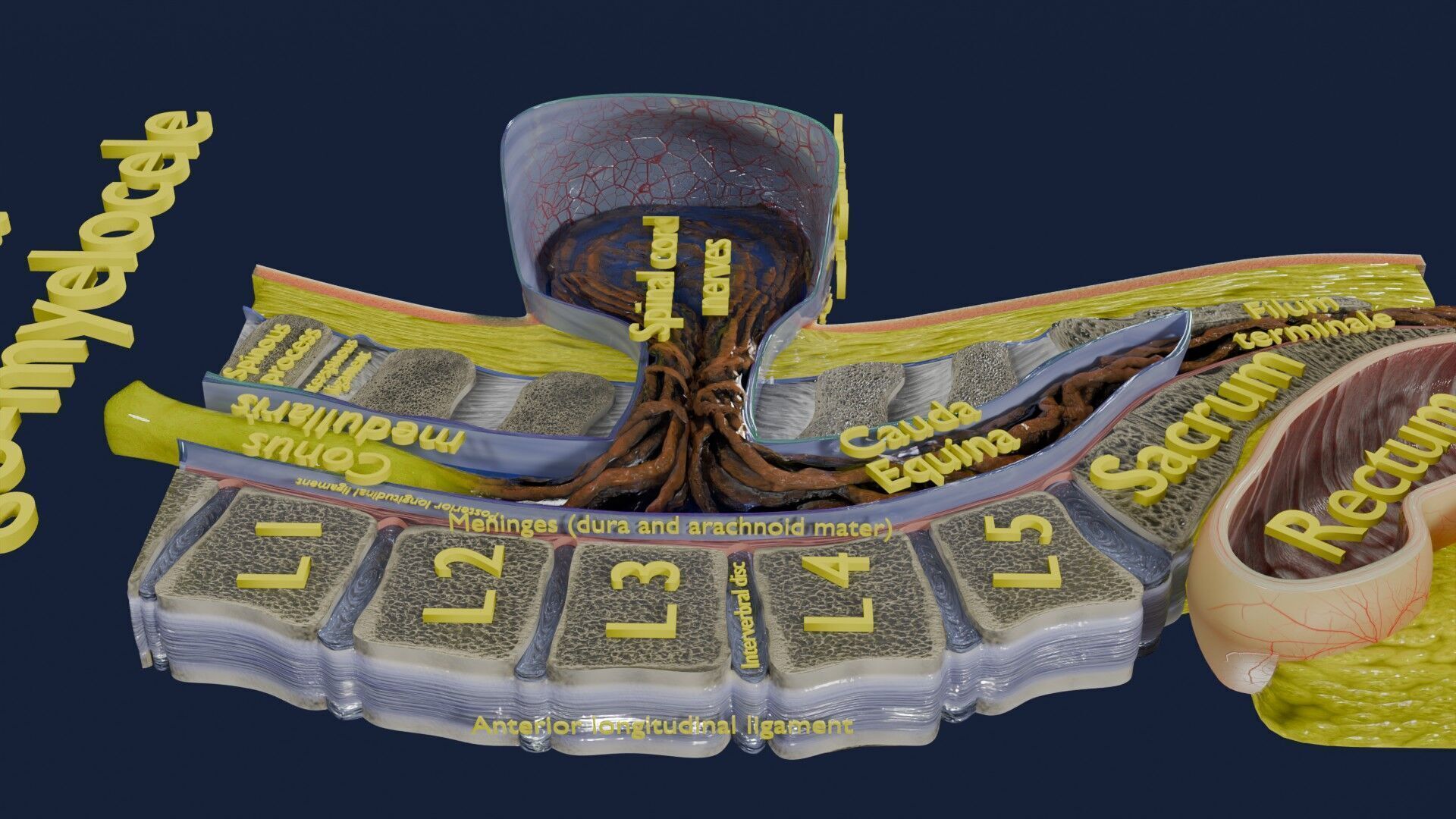 Spina bifida Neural Tube Defect Low-poly 3D model_47