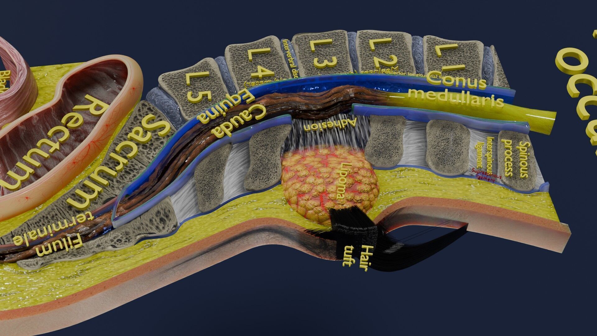 Spina bifida Neural Tube Defect Low-poly 3D model_52