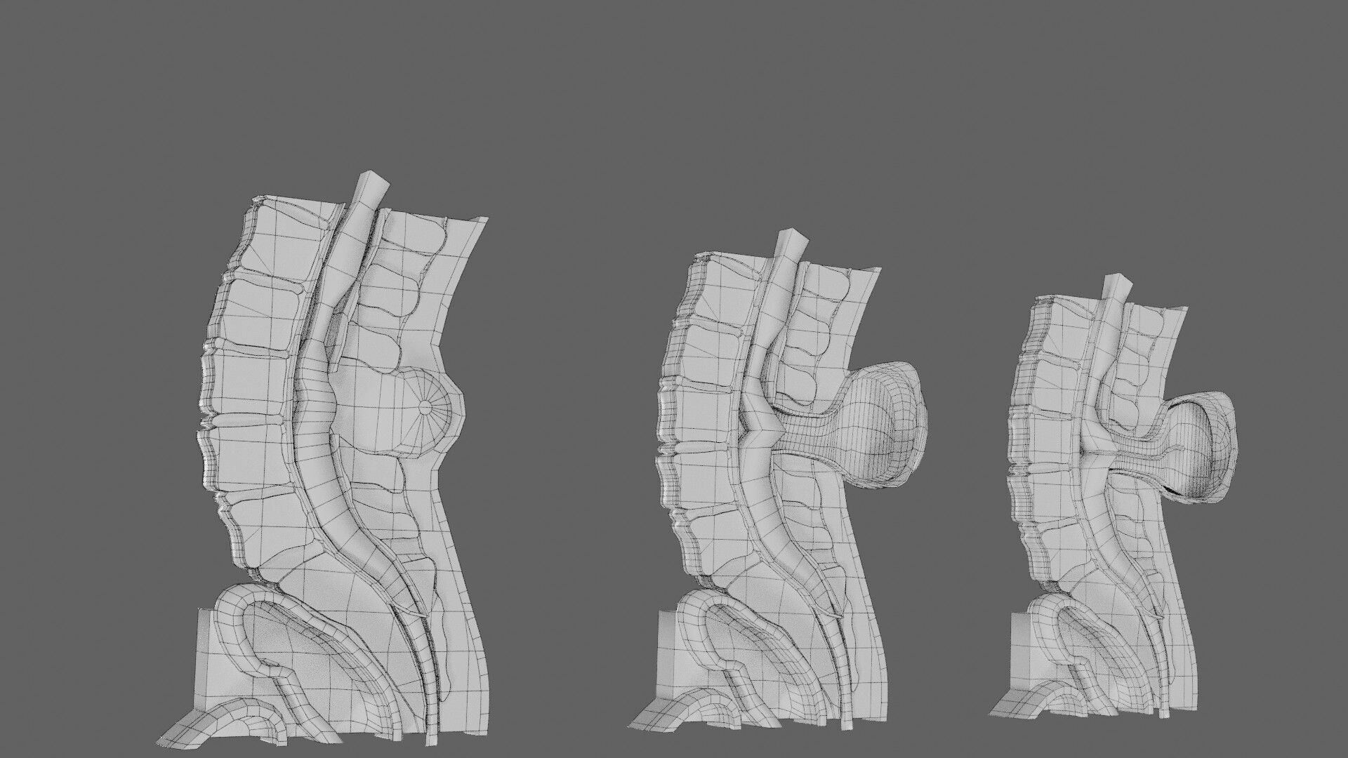 Spina bifida Neural Tube Defect Low-poly 3D model_95