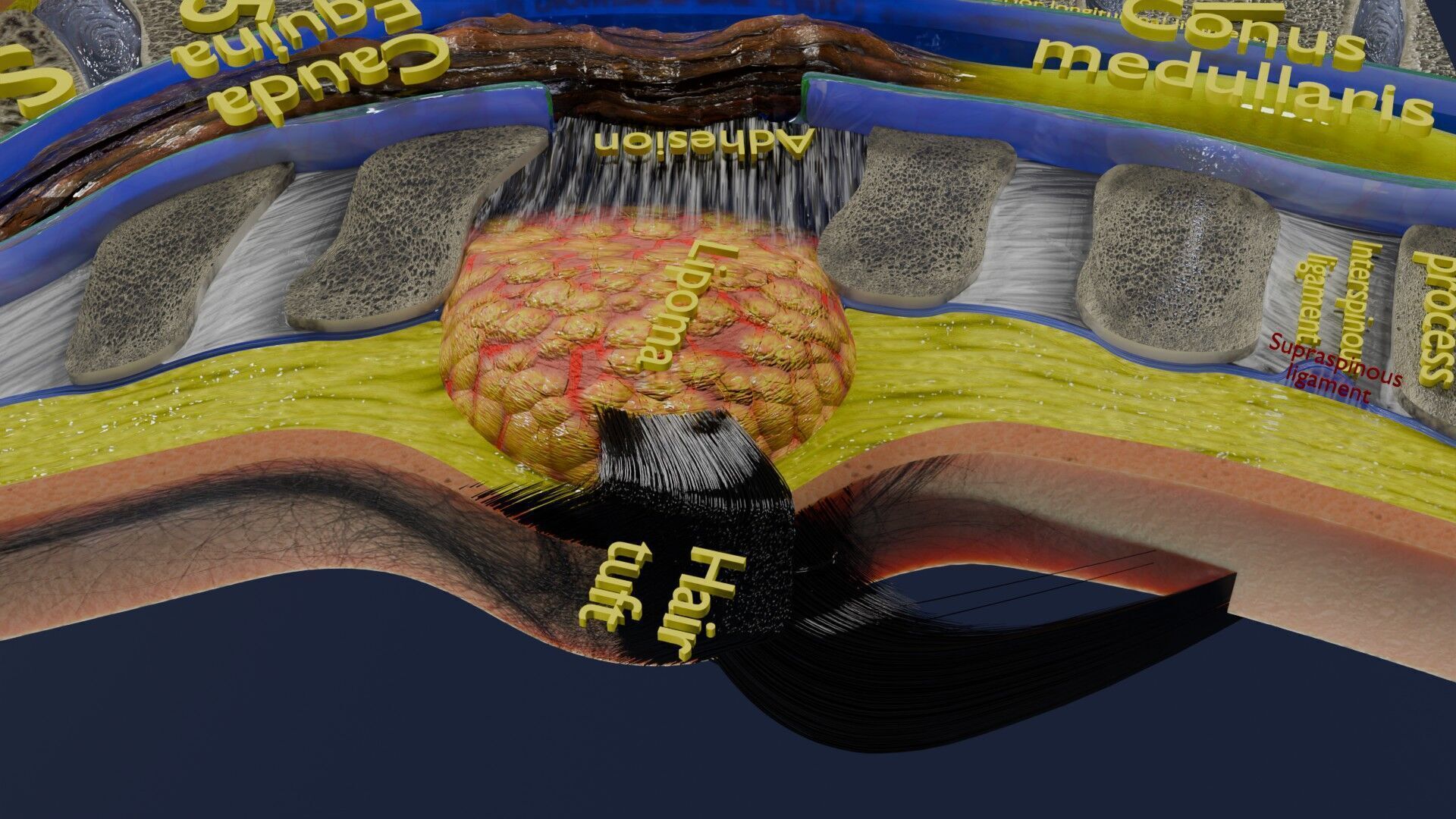 Spina bifida Neural Tube Defect Low-poly 3D model_30