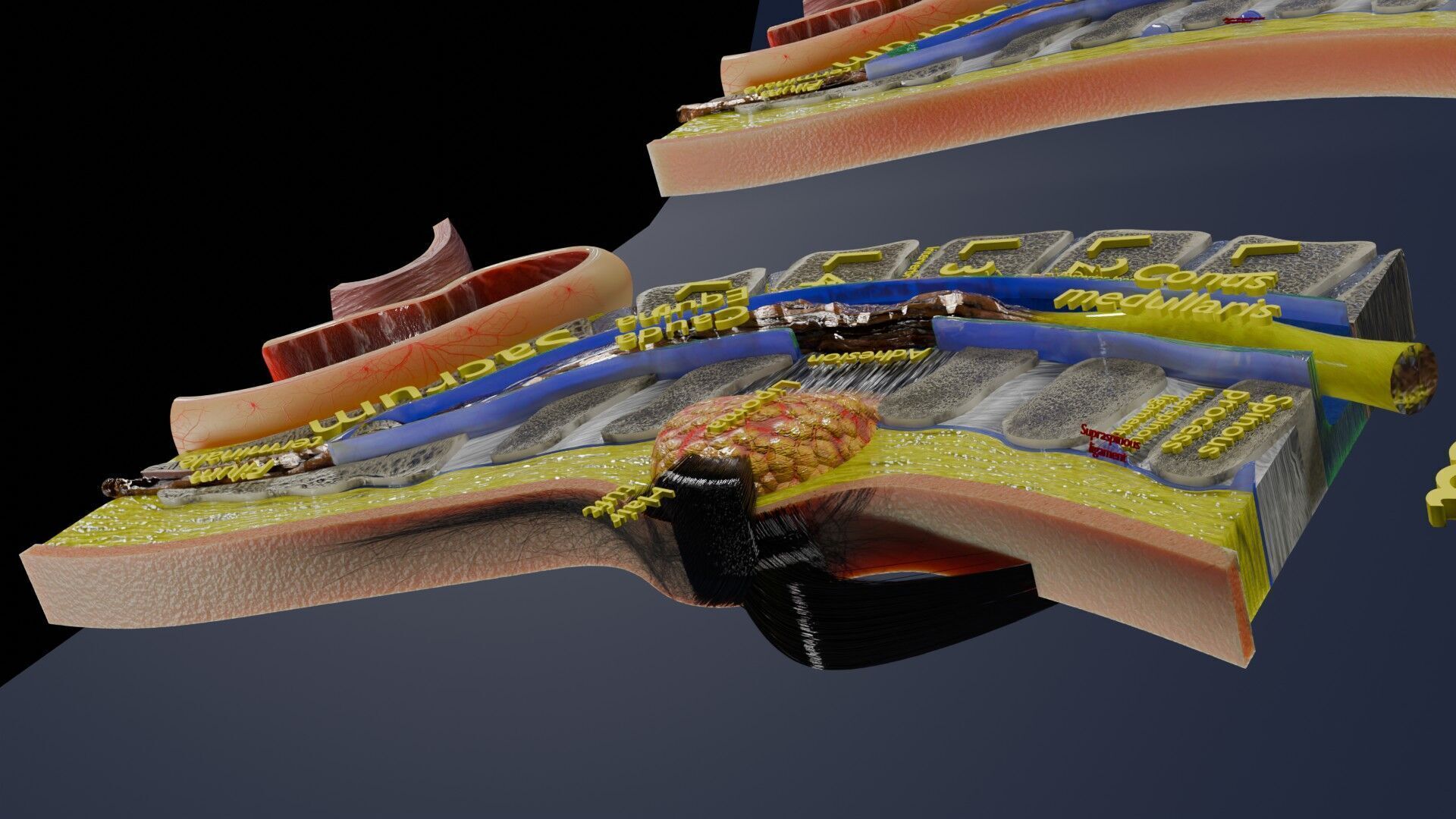 Spina bifida Neural Tube Defect Low-poly 3D model_25