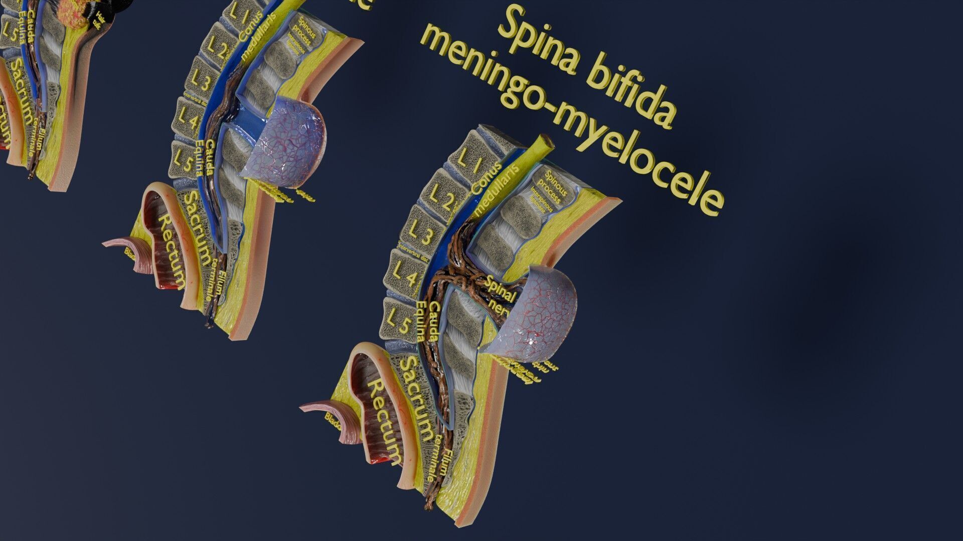 Spina bifida Neural Tube Defect Low-poly 3D model_48