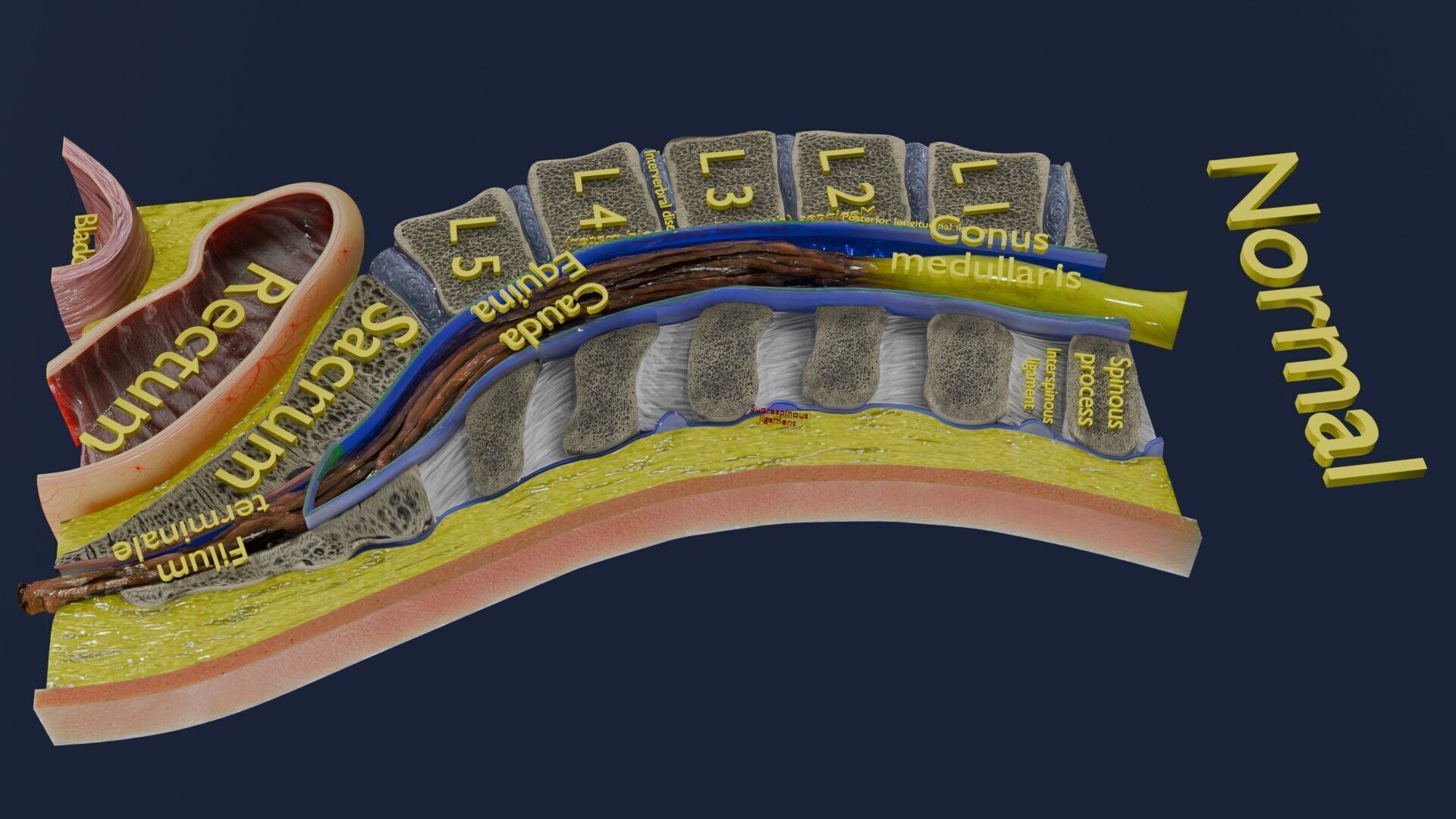 Spina bifida Neural Tube Defect Low-poly 3D model_29