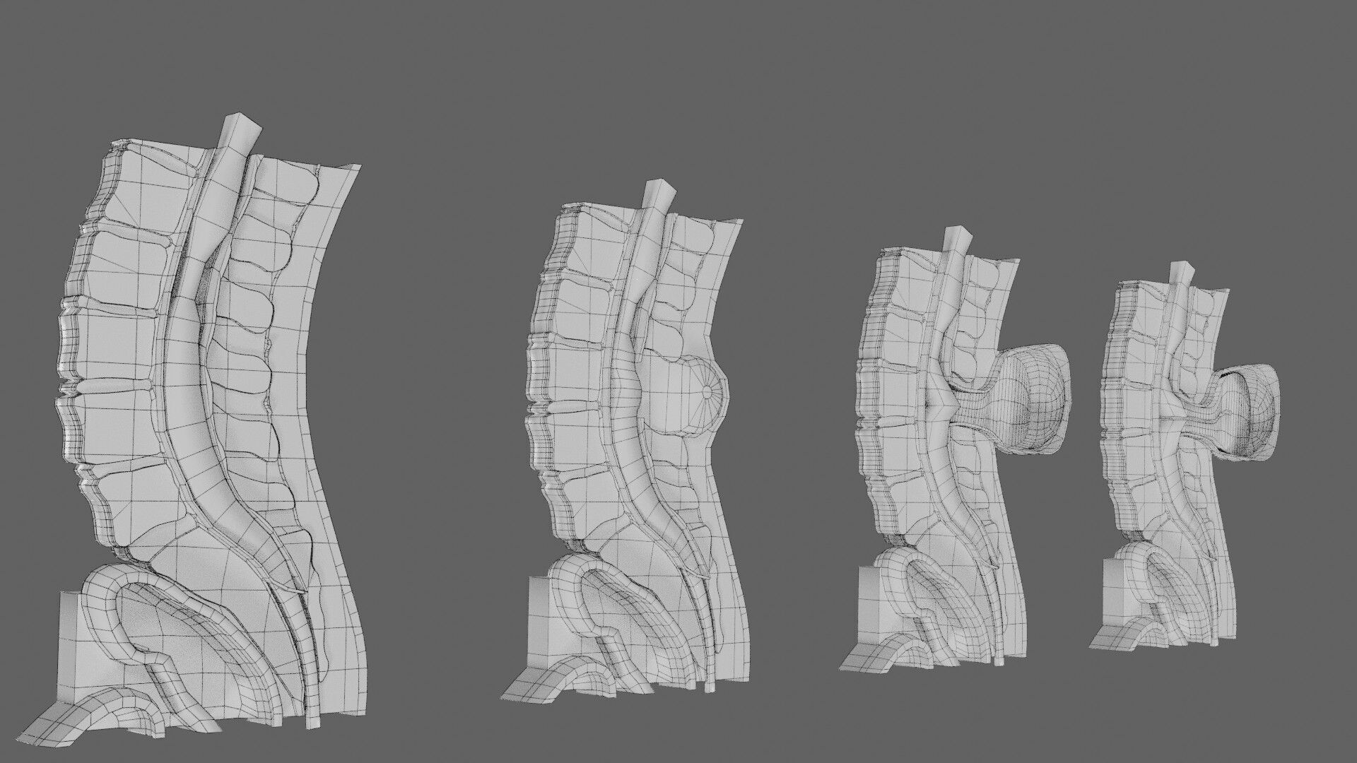 Spina bifida Neural Tube Defect Low-poly 3D model_78