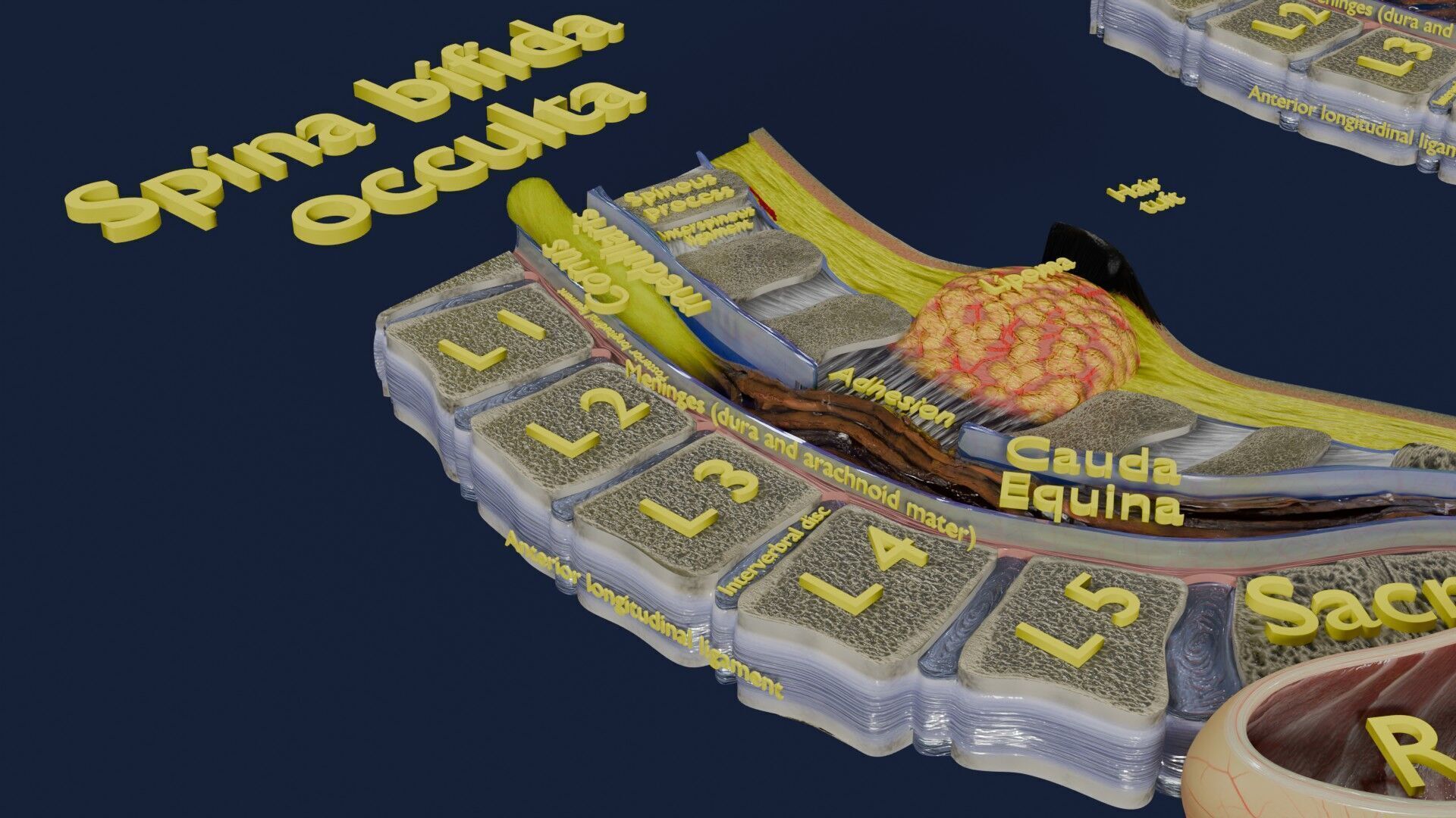 Spina bifida Neural Tube Defect Low-poly 3D model_26