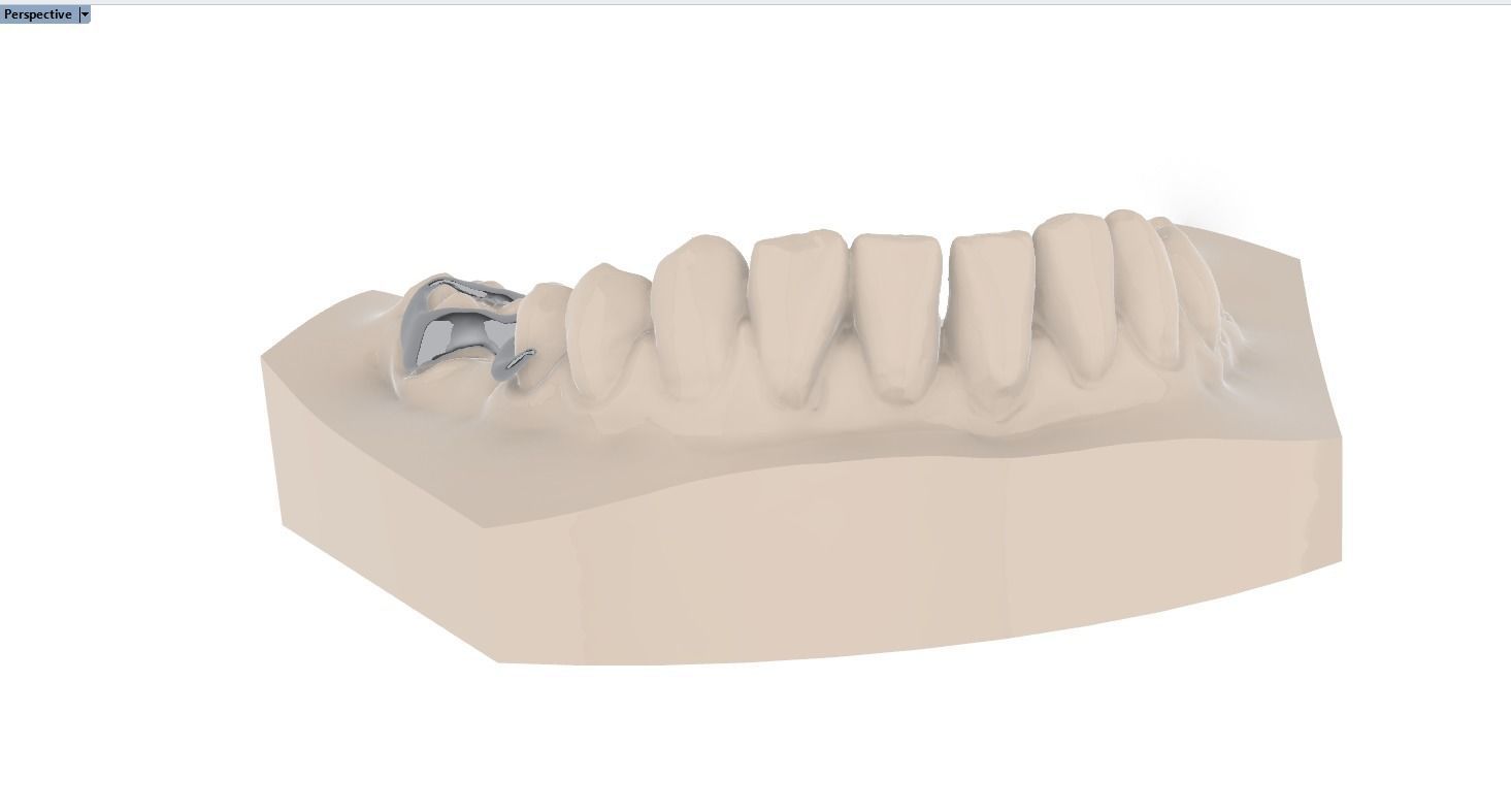 Digital Space Maintainer Appliance 3D print model_4