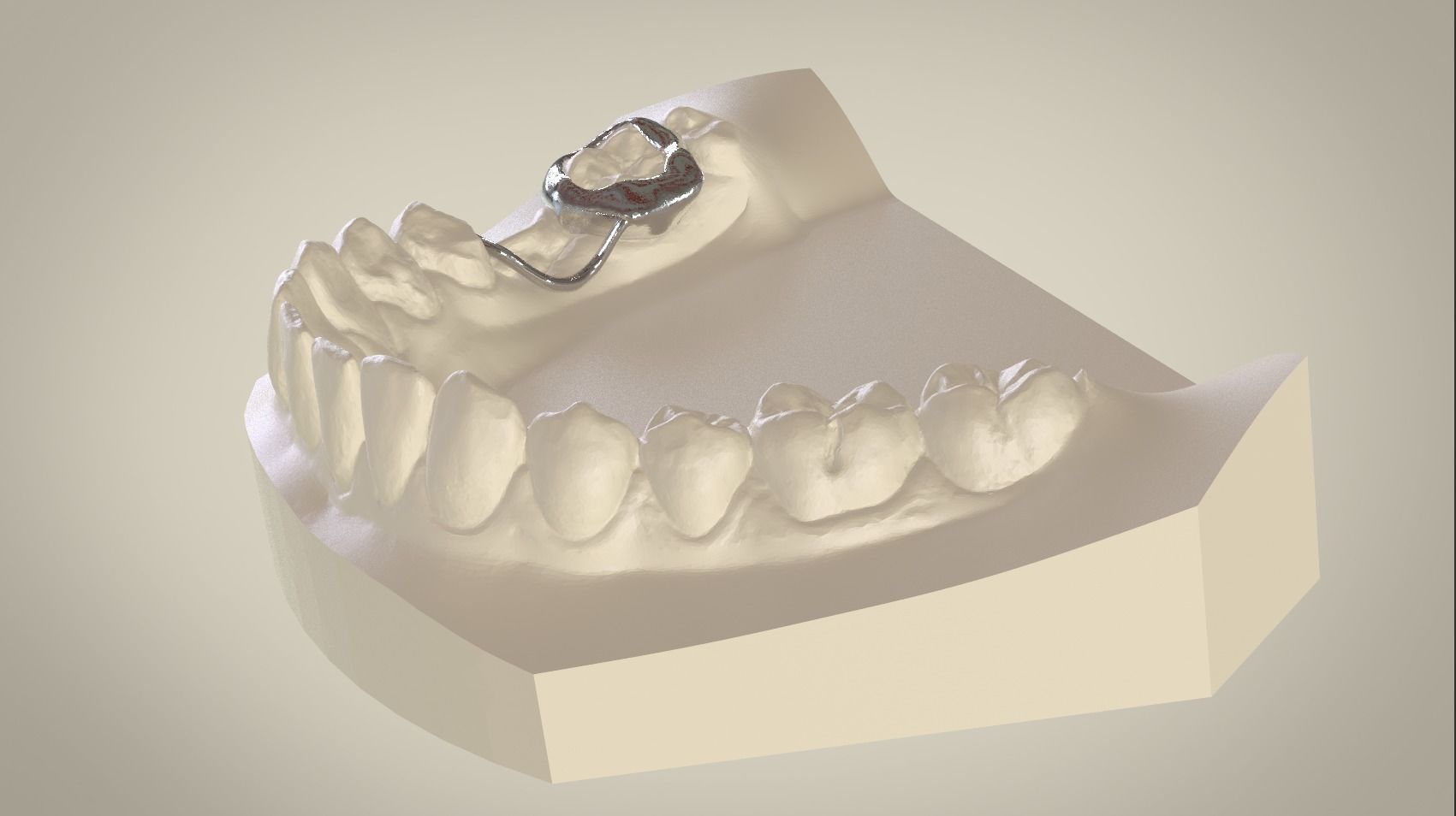 Digital Space Maintainer Appliance 3D print model_11