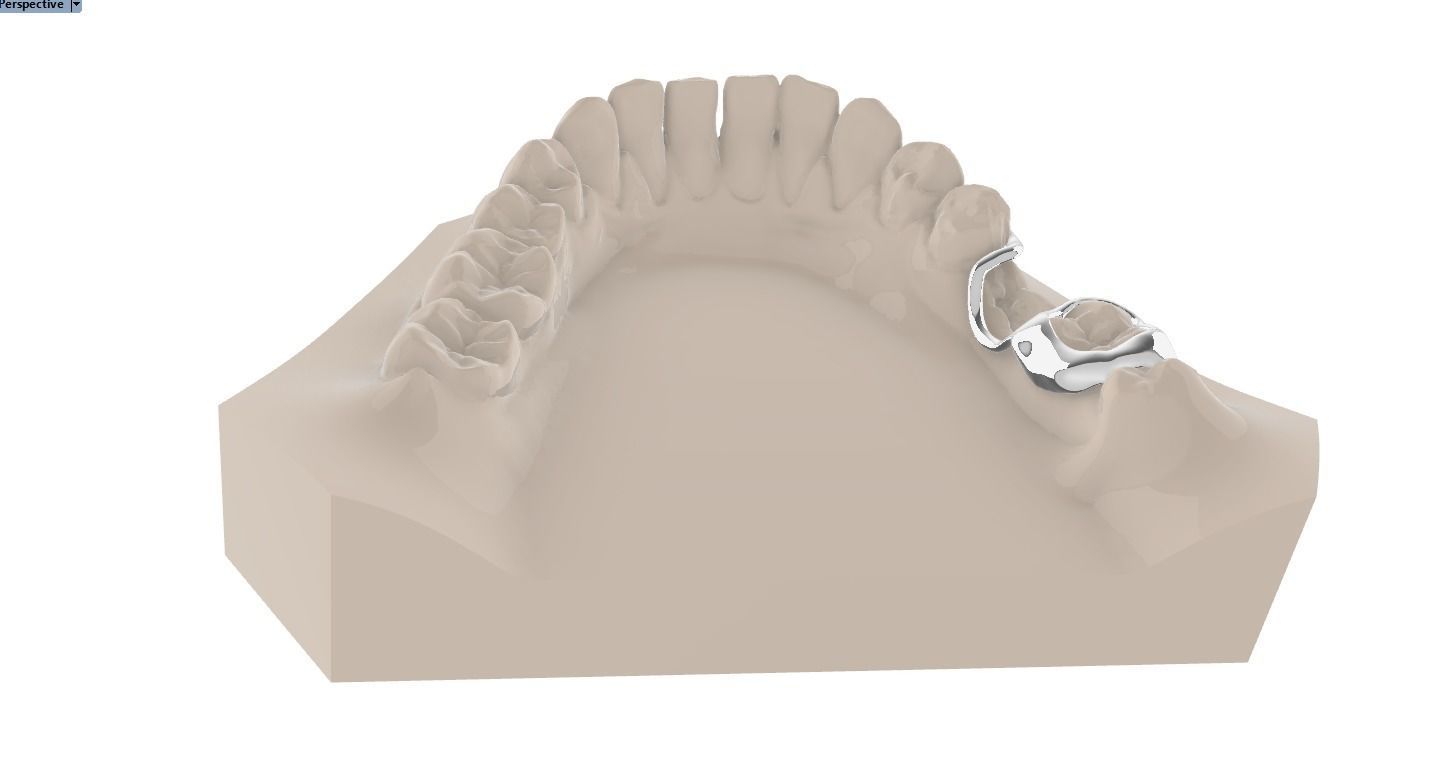 Digital Space Maintainer Appliance 3D print model_12
