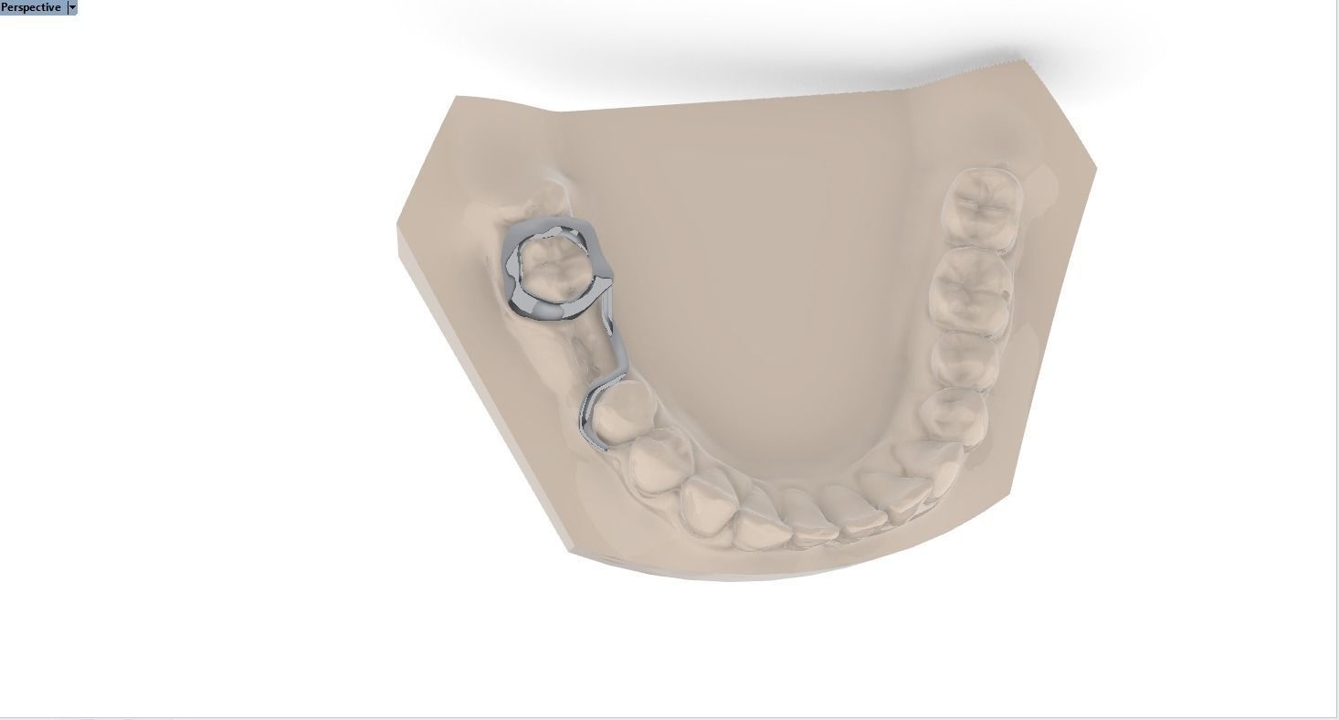 Digital Space Maintainer Appliance 3D print model_5