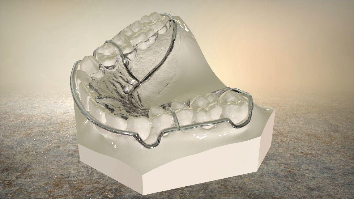 Digital Circumferential Wrap-around Retainer 3D print model_2