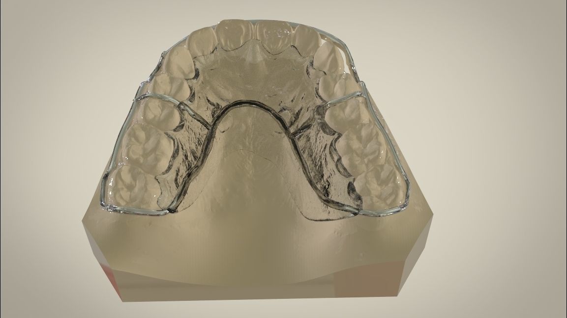 Digital Circumferential Wrap-around Retainer 3D print model_3