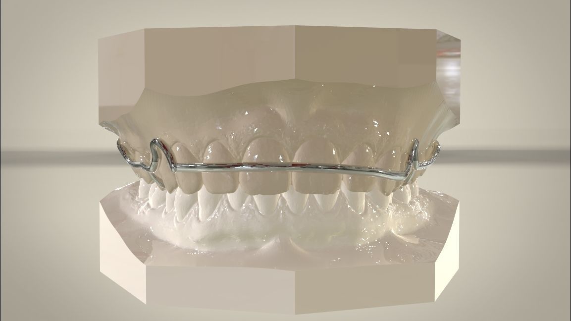 Digital Circumferential Wrap-around Retainer 3D print model_5