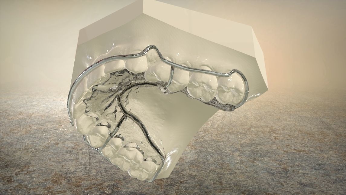 Digital Circumferential Wrap-around Retainer 3D print model_7