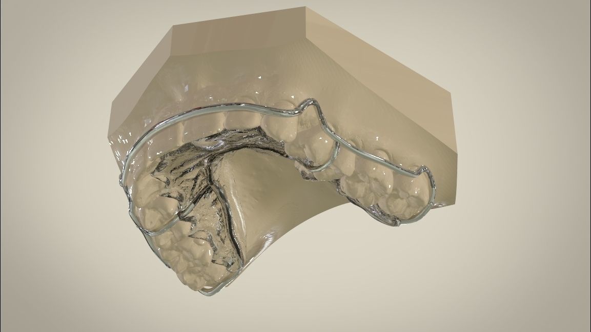 Digital Circumferential Wrap-around Retainer 3D print model_4