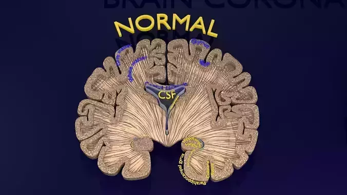 Hippocampus atrophy levels MTA 1-4 Low-poly 3D model