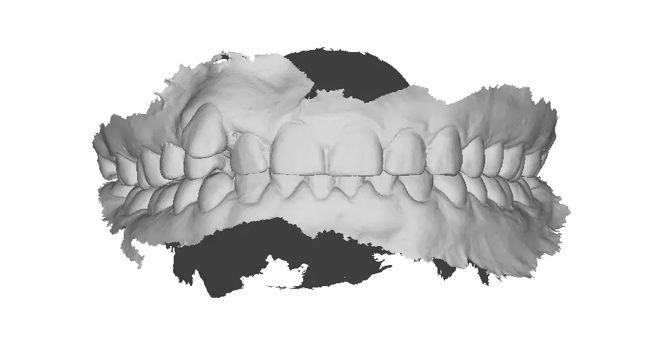 P006 - Dental - Intraoral Scan STL-PLY-OBJ 3D print model